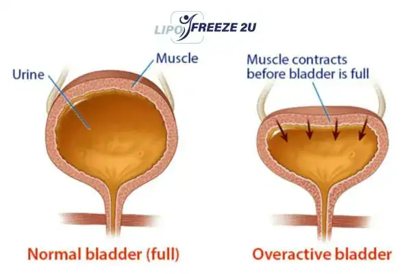 diagram of overactive bladder treatment Guildford