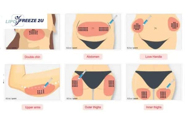 Benefits of Choosing Aqualyx for Fat Reduction Guildford