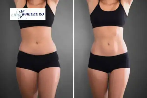 How Can LIPO FREEZE 2U Support Your Post-Pregnancy Body Recovery Guildford?