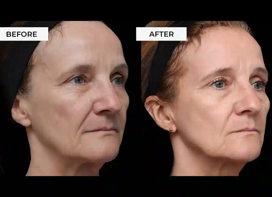 How Many RF Microneedling Sessions Will You Need to See a Difference Guildford?