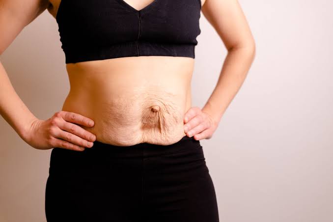 Is Surgery Really the Only Way to Repair Diastasis Recti Guildford?