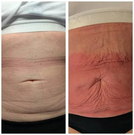 How Does RF Microneedling Improve Crepey, Thin and Uneven Skin Texture Guildford?
