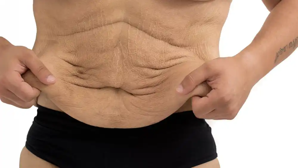 Why Does Weight Loss Medication Leave Some People With Loose or Sagging Skin Guildford?